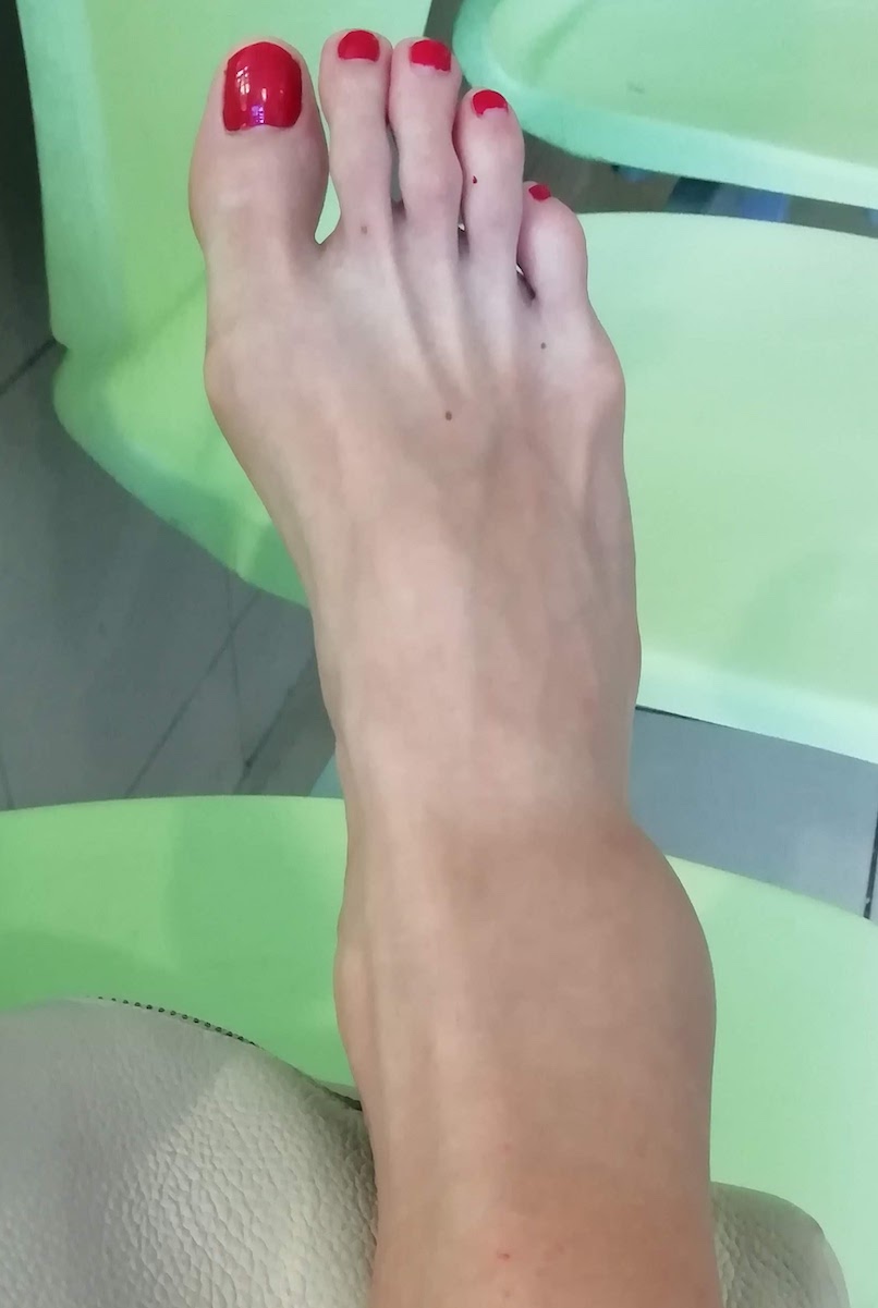 A futók leggyakoribb sérülései-2